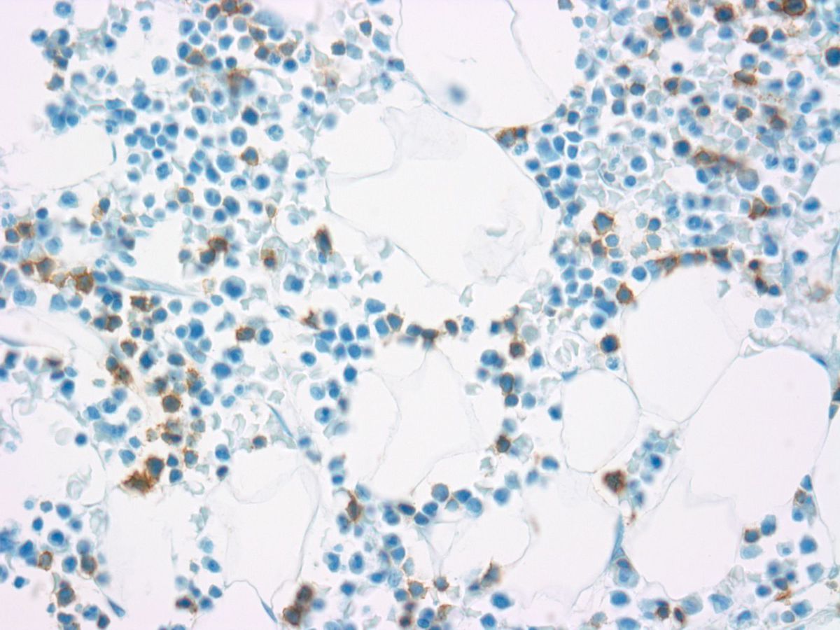 Bone marrow Biopsy: Variably CD20 positive B- lymphoblasts